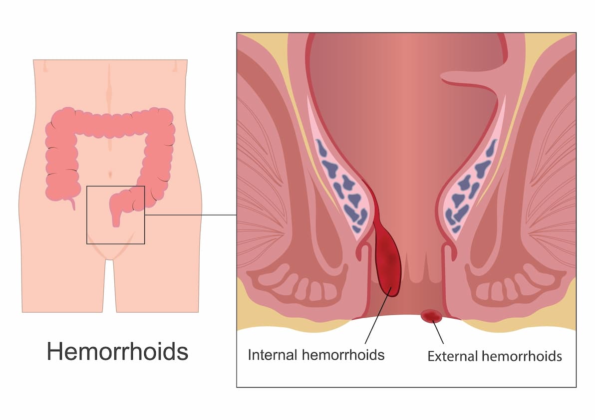 Medical diagram showing internal and external hemorrhoids in the anal canal