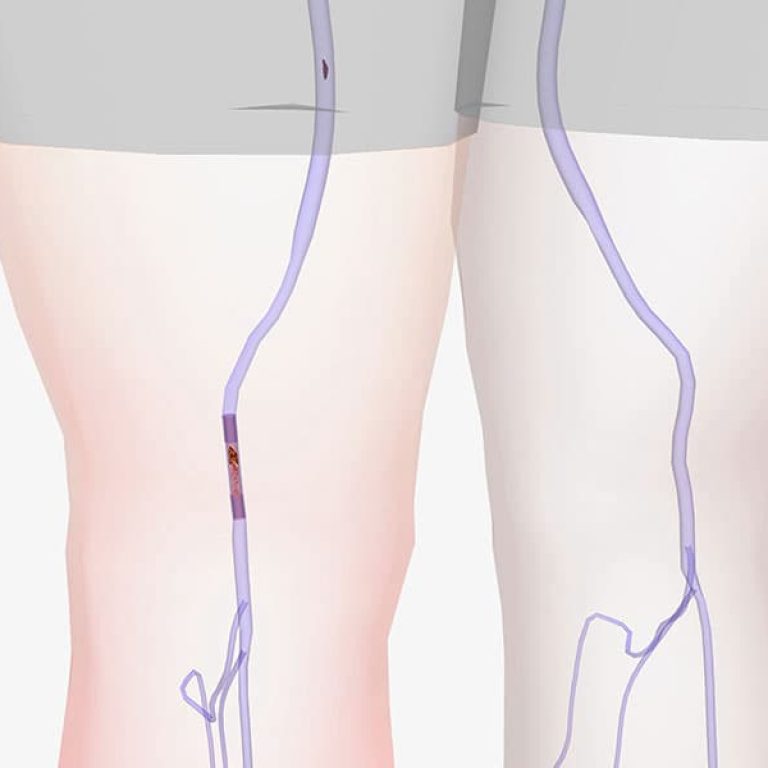deep-vein-thrombosis-Main-Banner