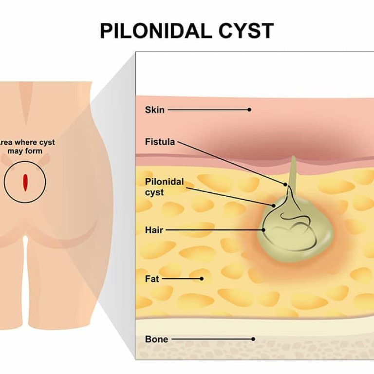 An illustration of a pilonidal cyst